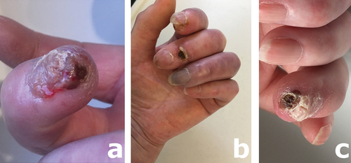 Figure 2. Necrotic, infected ulcer at the tip of the right middle finger (a), and photograph of the left had showing an ulcer at the tip of the index finger, an ulcer overlying the middle finger distal interphalangeal joint, and a dusky colored, critically ischemic ring finger which had an ulcer at the fingertip not seen on this view but demonstrated (one month later) in (c).