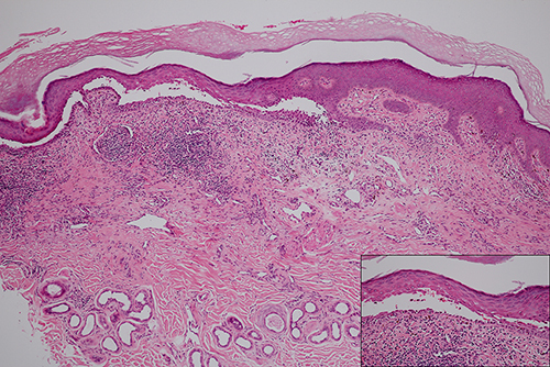 Figure 3 Histopathological examination of PNP showing suprabasal separation with lichenoid lymphocytic infiltration (H&E, ×10); acantholytic keratinocytes with tombstone appearance (inset, ×40).
