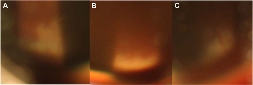 Figure 2 Slit-lamp photography of the superior retina by examination with a 90 diopter Volk lens. (A–C) Slit-lamp photography of the superior retina by examination with a 90 diopter Volk lens shows retinal necrosis spreading circumferentially in the periphery.