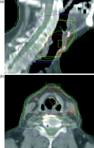 Figure 1. CT slices showing target volumes and dose distributions for a typical radiation treatment in the a) sagittal plane and b) transversal plane. Volumes: Yellow (2) = GTV, Red (7) = PTV (T), Yellow (3) = PTV (N), Green (8) = spinal cord. Isodoses:Orange = 68.0 Gy (105%), Green = 61.4 Gy (95%), Blue = 40.8 Gy (63%), Lilac = 20 Gy (30%) Field sizes:0–40.8 Gy = 14×11 cm 40.8–64.6 Gy = 8×9.5 cm CT = computer tomography, GTV = gross tumor volume, PTV(T) = planning target volume (tumor), PTV(N) = planning target volume (node).