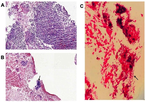 Figure 2 Pathology findings with inflammatory cells infiltration (A) and bacteria cluster (B) (HE, ×200). Gram staining of lung tissues showed a variety of bacteria (C). Black arrows indicate bacteria evidence.