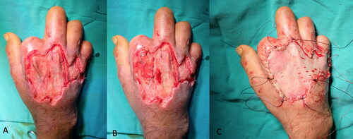 Figure 6. PAT graft application. A: Exposure of second extensor tendons right after debridement. B: PAT grafts were utilized over the exposed tendons.(Dorsum of index digit). C: Split thickness skin grafting was performed simultaneously.