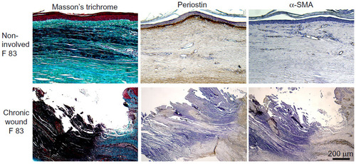 Figure 3 Periostin expression is reduced in human nonhealing skin wounds and correlates with a reduction in α-SMA expression and collagen content. Tissue was isolated at elective amputation from an 83-year-old female with type 2 diabetes.
