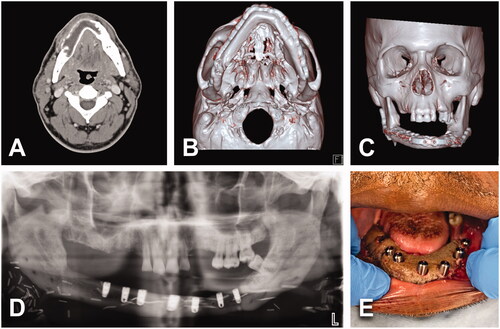 Figure 6. (A) A 51-year-old male with 7.9 × 2.9 cm2 multicystic ameloblastoma of the right mandibular body, extending across midline up to left body. No history of comorbidities; however, tobacco consumption (0.5 ppd for 30 years). BMI of 33 kg/m2. (B, C) Lesion was treated with tracheostomy, segmental mandible resection, right submandibular gland resection, 3 segments right FFF and bilateral IAN grafting. Length of stay of 11 days. Patient had delayed healing of donor site at the right leg. (D, E) One year after primary surgery, patient got multiple dental implants. Patient experienced intraoral dehiscence and exposure of reconstruction plate responding satisfactorily to hardware removal.