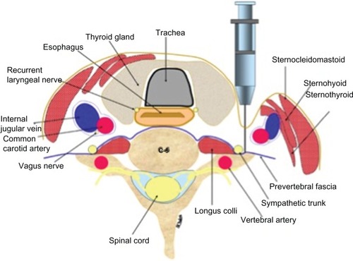 Figure 1 Cross-sectional anatomy at the C5–C6 level.