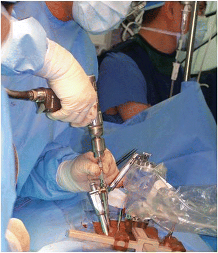 Figure 5. Drilling into the pedicle through the SpineAssist's cannulated guide.