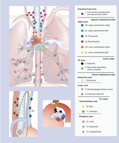 Figure 1. International Association for the Study of Lung Cancer nodal chart with stations and zones.Adapted with permission courtesy of the International Association for the Study of Lung Cancer. Copyright © 2009 Memorial Sloan-Kettering Cancer Center, NY, USA.