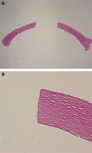 Figure 4 (A) Light microscopy evaluation with hematoxylin and eosin staining at 2× magnification demonstrating smooth-cut edges with minimum coagulative-type changes of laser-trephinated tissue. (B) Magnification at 10× of laser-trephinated edge.