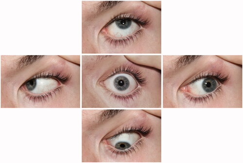Figure 2. Five positions of gaze photographed to provide a wider view of the scleral vasculature.