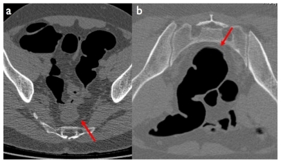 Figure 2 Computed tomography colonography image in the supine a) and prone b) position. In the supine position the collapsed sigmoid colon may mimic cancer, while on the prone position the bowel walls and the lumen are shown to be normal (red arrows).