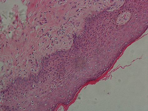 Figure 4 Pathology sampling biopsy three months after the end of treatment.(Hematoxylin and eosin;×20).