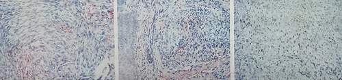 Figure 3 The patient’s orbital skin biopsy:CD34(+) CDX2(-) D2-40(+) HHV8(+) Ki-67(50%+).