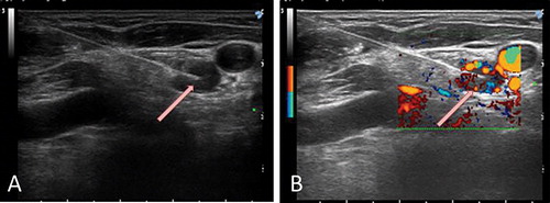 Figure 2. Neck Ultrasound Examination during treatment. Ultrasound-guided percutaneous laser ablation of the pathologic lymph-node showed in Figure 1. (A) the US image demonstrates the insertion of the optical fibre in the pathologic lymph-node (white arrow). (B) colour Doppler monitoring of the target lesion during US-guided laser treatment (white arrow).