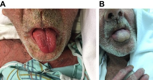 Figure 3 (A) Normal appearance of the patient’s tongue. (B) Raynaud’s phenomena of the tongue with central whitening of the lingua after drinking cold water.