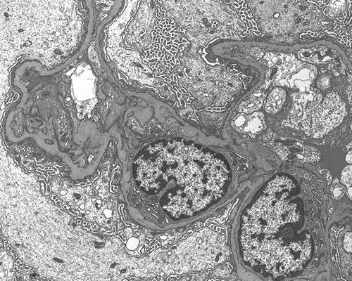 Figure 3. Glomerular ultrastructure. Podocytes show diffuse effacement of podocytes with cytoplasmic microvillous transformation zones compatible with minimal change disease (uranyl acetate, lead citrate ×11.600).