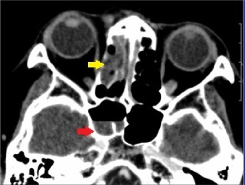 Figure 3 Contrast-enhanced computed tomography of the brain, orbit, and paranasal sinuses.