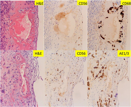 Figure 3. Vasculopathy in the decidual capsularis (fetal membrane roll) with immunostaining for CD56, CD68 and (pancytokeratin) AE1/AE3. Two separate vessels are shown in H& E with corresponding immunostaining. All sections are at 200× magnification.