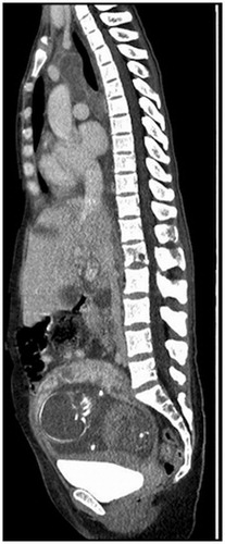 Figure 1. Diagnostic low dose sagittal CT scan demonstrating malignant involvement of the mediastinum, liver and L1 vertebrae as well as the presence of a growing fetus in utero.