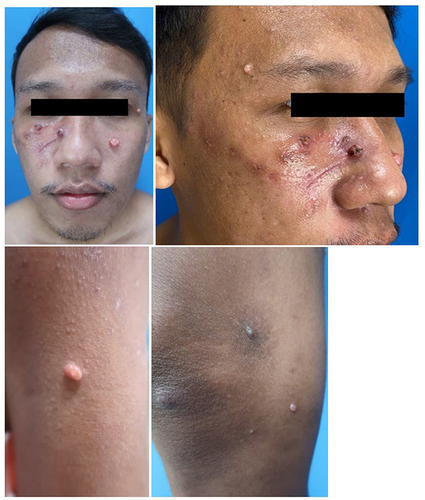 Figure 4 Clinical manifestation of MC lesion on face, right arm, and right leg before therapy, after 54th days of therapy.