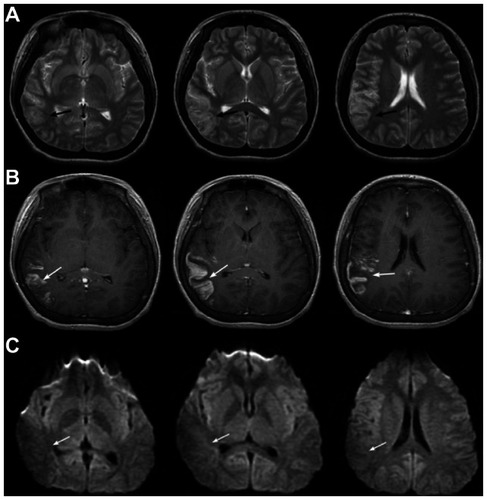 Figure 3 Case 2: brain magnetic resonance imaging (MRI) showed subacute to chronic infarction with hemorrhagic transformation lesions along the gyri of the right temporoparietal lobe, with mild hyperintensity and hypointensity linear lesions on T2-weighted imaging (A), gyriform enhancement on postenhanced T1-weighted imaging (B), and mild hypointensity on diffusion-weighted imaging (C).