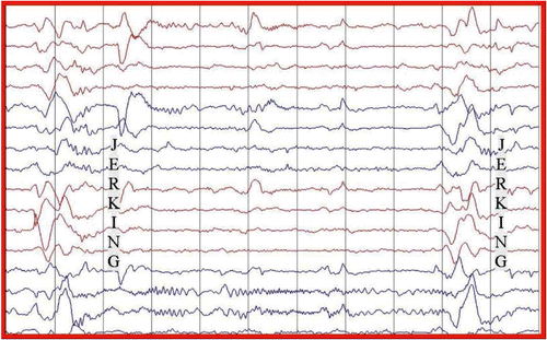 Figure 2: EEG shows a slow background with periodic complexes coincident with patient’s jerks.