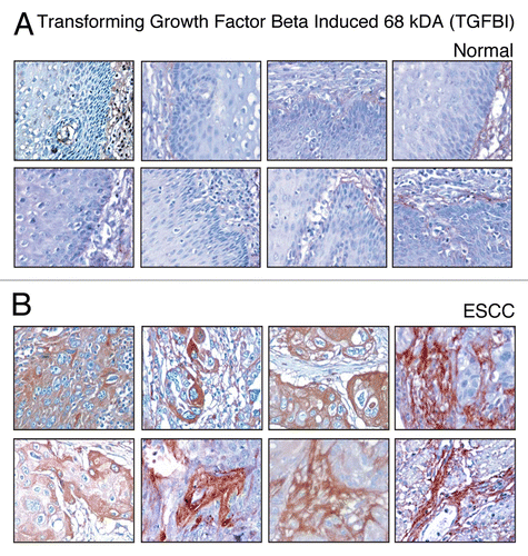 Figure 5 Validation of TGFBI using immunohistochemical labeling. Expression of TGFBI in representative normal esophageal squamous mucosa (A). Expression of TGFBI in ESCC is observed in both stromal and epithelial cell compartments (B).