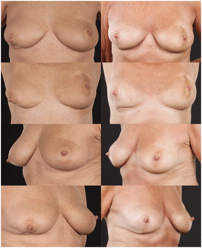 Figure 6. A 66-year-old woman with bilateral defects after BCS and RT (left). Time from RT to AFT was 2.6 years for the left breast and 1 year for the right breast. She underwent two AFT procedures to each breast with totally 69 ml to the left side and 100 ml to the right. In addition, she underwent mastopexy on the right side. Post-operative images from the 2-year follow-up are shown to the right.