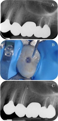 Figure 2 Clinical example in which the root canal treatment was performed without coronal disassembling.