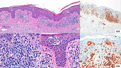 Figure 4 Epidermotropic infiltrate with Pautrier’s microabscesses with atypical lymphocytes and a patchy lichenoid infiltrate in the papillary dermis.