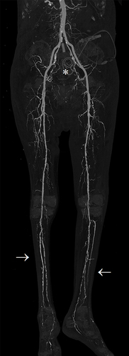 Figure 4 The pattern of PAD in a patient with renal failure. Following contrast administration, the maximal intensity projection image of lower limbs CTA demonstrates a moderate burden of atheromatous and atherosclerotic plaques causing multi-segmental stenoses predominantly in distal lower extremities (arrows). Furthermore, the pelvis harbors a looped peritoneal dialysis catheter denoting the status of dialysis dependency (asterisk).