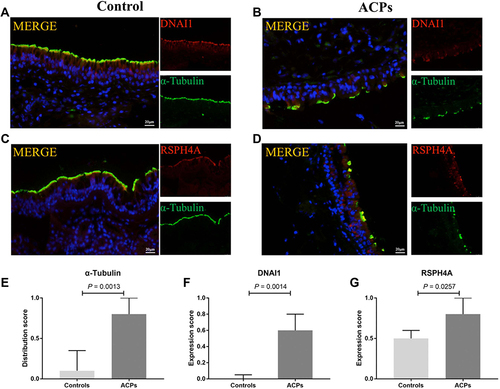 Figure 3 Comparison of the protein expression levels of a-Tubulin, DNAI1 and RSPH4A in patients with ACPs and healthy controls. Shown in the figure are the expression levels of DNAI1 (A, B and F), RSPH4A (C, D and G) and a-Tubulin (A–D and E) in patients with ACPs (n = 13) and healthy controls (n = 6). Abnormal ciliary distribution patterns and ciliary ultrastructural markers expressions were shown in ACPs. Data were analyzed by Mann–Whitney 2-sided nonparametric test. Median values with 25th and 75th percentiles are indicated by scale bar. P < 0.05 was statistically significant. DNAI1 and RSPH4A, Red; a-Tubulin, Green; DAPI, Blue.