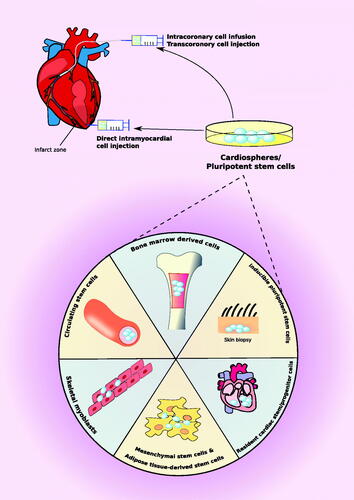 Figure 1. Stem cell therapy in cardiovascular disease. Potential sources of stem cell therapy for cardiovascular disease are bone marrow-derived cells, inducible pluripotent stem cells, resident cardiac stem cells, mesenchymal or adipose tissue-derived stem cells, skeletal myoblasts, and circulating stem cells. Once differentiated into cardiospheres, they can be directly injected into an infarct zone or indirectly delivered to an ischemic zone via intracoronary or transcoronory cell injection.