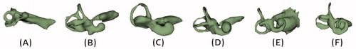 Figure 14. CH with different degrees of severity, starting from tiny bud-like appearance (A) to little development of the cochlea (B), to half of the basal turn (C, D), and one full turn of the cochlea (E, F). Image courtesy of MED-EL.