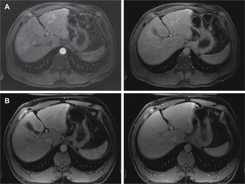 Figure 3 Interval MRI images from Case 2.