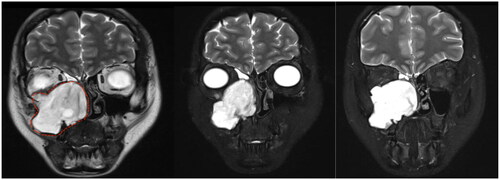 Figure 2. MRI of sinus showed a soft tissue mass of about 5.2 cm × 4.7 cm in size in the right maxillary sinus, septal sinus and middle and lower nasal passages, with low signal in T1WI and high signal in T2W. Enhancement scan: the mass showed significant heterogeneous ‘brain gyrus-like’ enhancement.