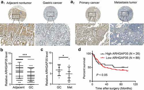 Figure 1. ARHGAP35 is downregulated in primary GC and metastatic tissues. a1-a2, The expression levels of ARHGAP35 were determined in GC tissue microarrays by immunohistochemistry. b-c, The expression score of ARHGAP35 in GC, metastatic GC and adjacent normal tissues is shown. **P < 0.05 and ***P < 0.001. d. The overall survival of patients with GC according to their ARHGAP35 expression levels was estimated by Kaplan-Meier analysis. ARHGAP35, Rho GTPase‑activating protein 35; GC, gastric cancer.