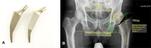 Figure 1 Metha® hip stem (130° left, 120° right) (A). Digital templating (mediCAD®) of a Metha® hip prosthesis with a Plasmafit® Cup System (B).
