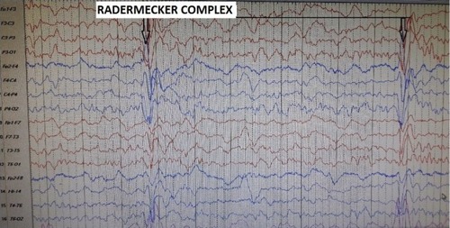 Figure 1 EEG of a patient with SSPE.