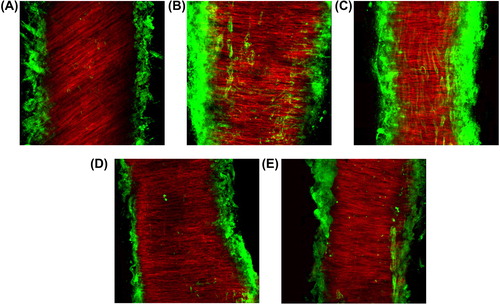 Figure 3. Representative Laser confocal microscopic images for collagen type I/III deposition in subcutaneous small resistance arteries from normotensive lean subject (A), normotensive and hypertensive obese patients (B and C, respectively), and normotensive and hypertensive obese patient after weight reduction (D and E, respectively). Vessels were labeled with rhodamin–phalloidin for smooth-muscle actin (red fluorescence) and with anticollagen type I/III (green fluorescence) and visualized by confocal microscopy.