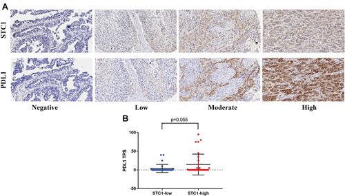 Figure 5 Association between STC1 and PDL1 expression. (A) Representative IHC images showing BLCA samples immunostained for STC1 and PDL1. (B) Different PDL1 expression according to STC1 levels.