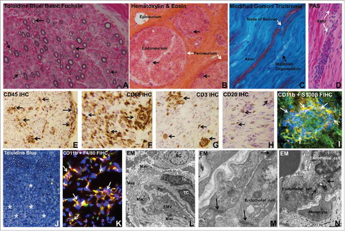 Figure 1. Histopathologic features of Guillain-Barré syndrome. Digital photomicrographs depict essential histopathological features of AIDP, the most common GBS variant in Western countries. Semi-thin plastic embedded axial section of the sural nerve biopsy of an AIDP patient shows thinly myelinated large diameter axons (black arrows), indicative of demyelination (A). Frozen thick axial section of the sural nerve biopsy shows mononuclear cells within the endoneurium with some perivascular foci (black arrows) in an AIDP patient (B). Longitudinal frozen thick section from the same AIDP patient's sural nerve biopsy shows reduction in large diameter axon density with evidence of Wallerian degeneration (black arrow). A node of Ranvier (white arrow) in an intact axon is shown (C). Leukocyte trafficking from endoneurial microvessels (EMV, white arrows) is another characteristic pathological finding in AIDP, as shown in the frozen longitudinal section of the sural nerve biopsy of an untreated AIDP patient stained with Periodic Acid Schiff (PAS) with high affinity for blood vessel walls that are rich in glycogen (D). Multifocal leukocyte infiltration (CD45+, black arrows) is commonly seen in AIDP patient nerve biopsies, as shown by immunohistochemistry (IHC) of a frozen thick axial section of a sural nerve biopsy (E). Macrophages (CD68+, black arrows) are the most prevalent endoneurial leukocyte subpopulation in AIDP (F), followed by CD3+ T-cells (black arrows, G) and CD20+ B-cells (black arrows, H). CD11b+ mononuclear leukocytes (white arrows) infiltrating into peripheral nerve endoneurium associated with demyelination of S100β Schwann cells is shown in a frozen thick section of an untreated AIDP patient sural nerve biopsy using indirect fluorescent immunohistochemistry (FIHC; I). An animal model of GBS, severe murine experimental autoimmune neuritis, recapitulates essential pathological features of AIDP, with diffuse areas of demyelination associated with mononuclear leukocyte infiltration (*) seen in the sciatic nerve endoneurium on a semi-thin, plastic-embedded axial section of an affected mouse at peak severity (J). As seen in AIDP, the most prevalent inflammatory leukocyte subpopulation observed in this murine GBS model is the monocyte/macrophage (F4/80+) and these cells are predominantly CD11b+ (white arrows, K) as shown in a frozen axial FIHC section. Electron microscopy (EM) demonstrates macrophages (Mac), T-cells (TC) and B-cells (BC) in the endoneurium of an AIDP patient sural nerve biopsy close to an endoneurial microvessel (EMV) that forms the blood-nerve barrier, sharing its basement membrane with a pericyte (Pc), as shown in L. In this region of leukocyte infiltration, higher magnification demonstrates intact electron dense interendothelial cell tight junctions (black arrows, M). In another region showing active monocyte transmigration, intact tight junctions persist between endoneurial endothelial cells and the migrating monocyte during paracellular diapedesis (black arrows, N). Unless indicated, the stains or histological technique performed on each section are indicated at the upper left corner of the photomicrograph.