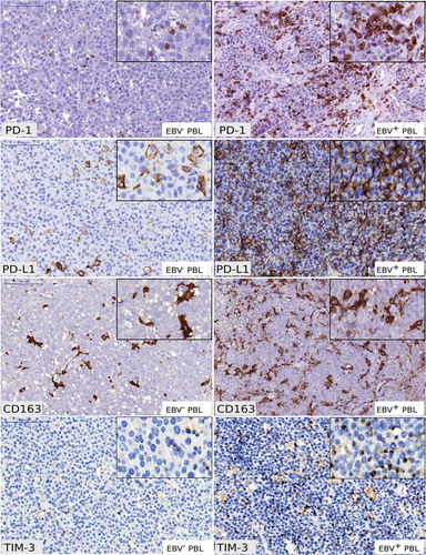 Figure 3. Immunohistochemical analysis of PD-1, PD-L1, CD163 and TIM-3 in EBV− and EBV+ plasmablastic lymphomas.Examples of PD-1 staining in EBV− and EBV+ PBL showing scattered intra-tumoral lymphocytes PD-1+ (x200). Examples of PD-L1 staining showing distinct membranous staining in intra-tumoral macrophages PD-L1+ in EBV− PBL (x200) and tumor cells PD-L1+ in EBV+ PBL (x200). Examples of CD163 staining in EBV− and EBV+ PBL showing distinct membranous staining in intra-tumoral macrophages (x200). Examples of TIM-3 staining in EBV− and EBV+ PBL showing distinct membranous staining in intra-tumoral macrophages and intra-tumoral lymphocytes (x200). (Scale bars = 100µm for each panel) Typical IHC stainings of PBL cases #9 (EBV+ PBL) and PBL case #5 (EBV− PBL) are shown.