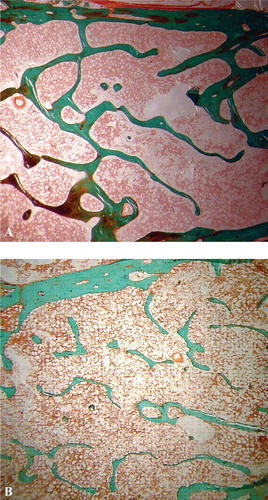 Figure 1. Photomicrographs showing the cancellous microanatomy in undecalcified transiliac histology sections from (A) young men where the network is well interconnected and (B) elderly men where the network is atrophied (×16).