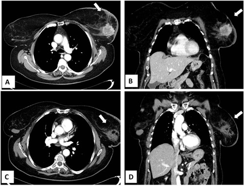 Figure 2 Cryoablation of invasive breast carcinoma in a 74-year-old woman presenting with distant metastases to the bones (Stage IV) at diagnosis. Axial (A) and coronal (B) contrast-enhanced CT scan showing a 4 cm mass in the left breast. (C–D). Contrast-enhanced CT scan 2 months after cryoablation showing tumor size reduction and absence of contrast enhancement.