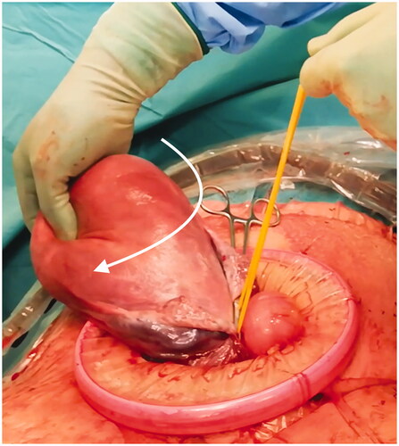 Figure 1. Uterus with 90° twist (arrow) and cervical sling (held in left hand) placed at cervix height, for blood supply blockage.