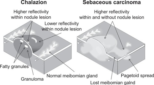 Figure 7 Schematic representation of the relationship between pathological characteristics and noninvasive meibography findings for chalazion and sebaceous carcinoma of the eyelid.