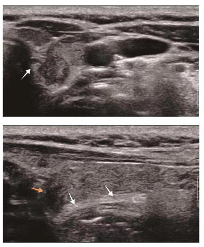 Figure 4 Gray-scale ultrasound image of a 65-year-old woman with a papillary thyroid tumor. The largest diameter of the tumor was 8 mm, and its infiltration of the RLN around Berry’s ligament was confirmed intraoperatively (white arrow, RLN; yellow arrow, thyroid tumor).