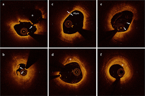 Figure 1 Representative cross-sectional image of various pathological features of culprit plaques acquired through optical coherence tomography. (a) Plaque rupture, identified by disrupted fibrous cap (↑) and underlying cavity (*); (b) Plaque erosion, identified by intact fibrous cap overlayed with thrombus (↑); (c) Thin-cap fibroatheroma, identified by low backscattering area (necrotic core) covered by fibrous cap (↑) with thickness < 65 μm; (d) Calcification, identified by signal-poor or heterogeneous region (*) with a sharply delineated border; (e) Macrophage infiltration, identified by signal-rich, highly backscattering, confluent or punctate focal regions (↑); (f) Healed plaques, identified by one or more heterogeneous signal-rich layer (*) of different optical signal intensities located near by the luminal surface and clearly demarcated from the underlying tissue.
