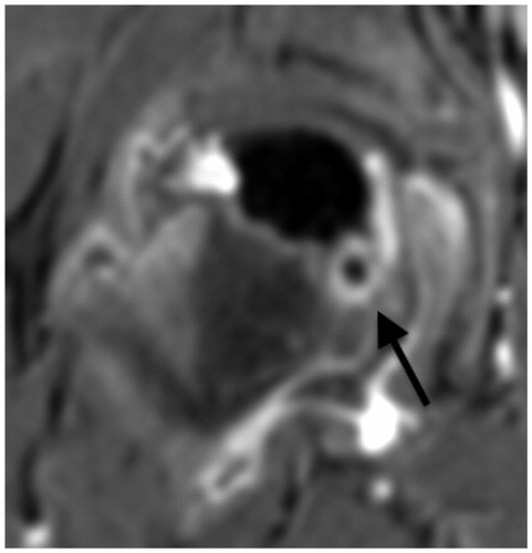 Figure 3. At 5.2 months. Contrast MRI. Cyst. Stage Ib. 2 days later, denosumab was administered.