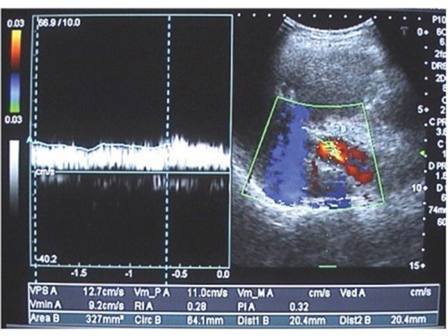 Figure 2 Colour Doppler sonography of the portal vein with maximum flow velocity of 12.7 cm/s, minimum flow velocity of 9.2 cm/s, and mean flow velocity of 11 cm/s. Portal vein cross-sectional area equals 20.4 mm.